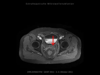 ZIRN.KHNW.FFM · SAINT 2011 · 3.-4. Oktober 2011
E x t r a h e p a t i s c h e M i k r o w e l l e n a b l a t i o n
 