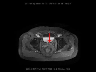 ZIRN.KHNW.FFM · SAINT 2011 · 3.-4. Oktober 2011
E x t r a h e p a t i s c h e M i k r o w e l l e n a b l a t i o n
 