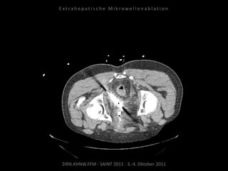 ZIRN.KHNW.FFM · SAINT 2011 · 3.-4. Oktober 2011
E x t r a h e p a t i s c h e M i k r o w e l l e n a b l a t i o n
 
