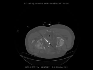 ZIRN.KHNW.FFM · SAINT 2011 · 3.-4. Oktober 2011
E x t r a h e p a t i s c h e M i k r o w e l l e n a b l a t i o n
 
