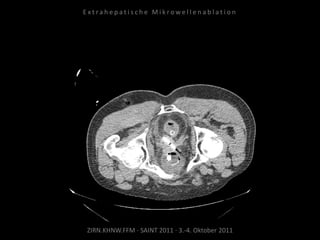 ZIRN.KHNW.FFM · SAINT 2011 · 3.-4. Oktober 2011
E x t r a h e p a t i s c h e M i k r o w e l l e n a b l a t i o n
 