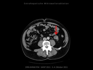 ZIRN.KHNW.FFM · SAINT 2011 · 3.-4. Oktober 2011
E x t r a h e p a t i s c h e M i k r o w e l l e n a b l a t i o n
 
