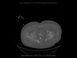 ZIRN.KHNW.FFM · SAINT 2011 · 3.-4. Oktober 2011
E x t r a h e p a t i s c h e M i k r o w e l l e n a b l a t i o n
 