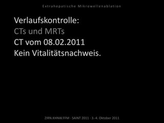 Verlaufskontrolle:
CTs und MRTs
CT vom 08.02.2011
Kein Vitalitätsnachweis.
ZIRN.KHNW.FFM · SAINT 2011 · 3.-4. Oktober 2011
E x t r a h e p a t i s c h e M i k r o w e l l e n a b l a t i o n
 