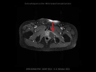ZIRN.KHNW.FFM · SAINT 2011 · 3.-4. Oktober 2011
E x t r a h e p a t i s c h e M i k r o w e l l e n a b l a t i o n
 