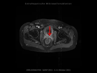 ZIRN.KHNW.FFM · SAINT 2011 · 3.-4. Oktober 2011
E x t r a h e p a t i s c h e M i k r o w e l l e n a b l a t i o n
 