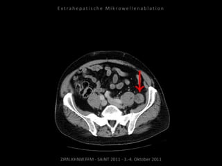 ZIRN.KHNW.FFM · SAINT 2011 · 3.-4. Oktober 2011
E x t r a h e p a t i s c h e M i k r o w e l l e n a b l a t i o n
 
