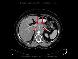 ZIRN.KHNW.FFM · SAINT 2011 · 3.-4. Oktober 2011
E x t r a h e p a t i s c h e M i k r o w e l l e n a b l a t i o n
 