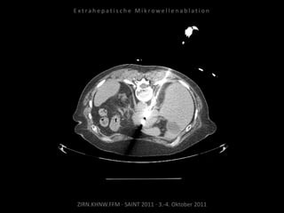 ZIRN.KHNW.FFM · SAINT 2011 · 3.-4. Oktober 2011
E x t r a h e p a t i s c h e M i k r o w e l l e n a b l a t i o n
 