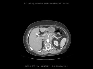 ZIRN.KHNW.FFM · SAINT 2011 · 3.-4. Oktober 2011
E x t r a h e p a t i s c h e M i k r o w e l l e n a b l a t i o n
 