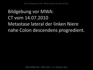 Bildgebung vor MWA:
CT vom 14.07.2010
Metastase lateral der linken Niere
nahe Colon descendens progredient.
ZIRN.KHNW.FFM · SAINT 2011 · 3.-4. Oktober 2011
E x t r a h e p a t i s c h e M i k r o w e l l e n a b l a t i o n
 