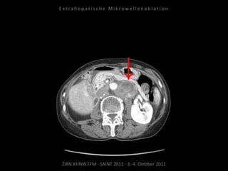ZIRN.KHNW.FFM · SAINT 2011 · 3.-4. Oktober 2011
E x t r a h e p a t i s c h e M i k r o w e l l e n a b l a t i o n
 