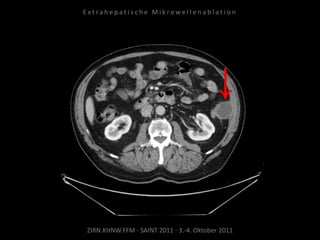 ZIRN.KHNW.FFM · SAINT 2011 · 3.-4. Oktober 2011
E x t r a h e p a t i s c h e M i k r o w e l l e n a b l a t i o n
 