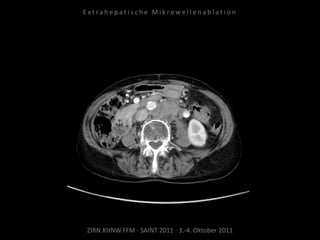 ZIRN.KHNW.FFM · SAINT 2011 · 3.-4. Oktober 2011
E x t r a h e p a t i s c h e M i k r o w e l l e n a b l a t i o n
 