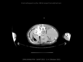 ZIRN.KHNW.FFM · SAINT 2011 · 3.-4. Oktober 2011
E x t r a h e p a t i s c h e M i k r o w e l l e n a b l a t i o n
 