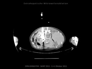 ZIRN.KHNW.FFM · SAINT 2011 · 3.-4. Oktober 2011
E x t r a h e p a t i s c h e M i k r o w e l l e n a b l a t i o n
 