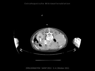 ZIRN.KHNW.FFM · SAINT 2011 · 3.-4. Oktober 2011
E x t r a h e p a t i s c h e M i k r o w e l l e n a b l a t i o n
 