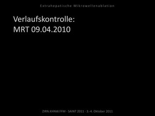 Verlaufskontrolle:
MRT 09.04.2010
ZIRN.KHNW.FFM · SAINT 2011 · 3.-4. Oktober 2011
E x t r a h e p a t i s c h e M i k r o w e l l e n a b l a t i o n
 