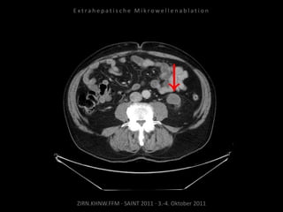 ZIRN.KHNW.FFM · SAINT 2011 · 3.-4. Oktober 2011
E x t r a h e p a t i s c h e M i k r o w e l l e n a b l a t i o n
 