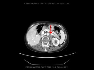 ZIRN.KHNW.FFM · SAINT 2011 · 3.-4. Oktober 2011
E x t r a h e p a t i s c h e M i k r o w e l l e n a b l a t i o n
 
