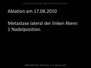 Ablation am 17.08.2010
Metastase lateral der linken Niere:
1 Nadelposition.
ZIRN.KHNW.FFM · SAINT 2011 · 3.-4. Oktober 2011
E x t r a h e p a t i s c h e M i k r o w e l l e n a b l a t i o n
 