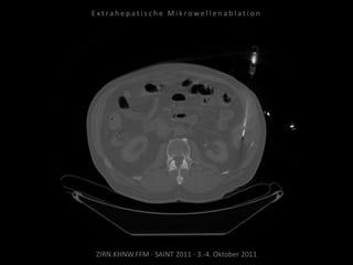 ZIRN.KHNW.FFM · SAINT 2011 · 3.-4. Oktober 2011
E x t r a h e p a t i s c h e M i k r o w e l l e n a b l a t i o n
 