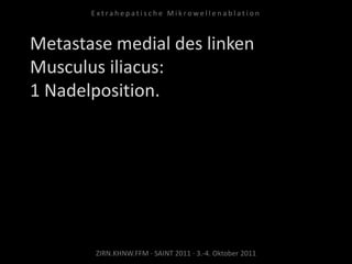 Metastase medial des linken
Musculus iliacus:
1 Nadelposition.
ZIRN.KHNW.FFM · SAINT 2011 · 3.-4. Oktober 2011
E x t r a h e p a t i s c h e M i k r o w e l l e n a b l a t i o n
 