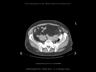 ZIRN.KHNW.FFM · SAINT 2011 · 3.-4. Oktober 2011
E x t r a h e p a t i s c h e M i k r o w e l l e n a b l a t i o n
 