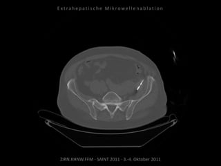 ZIRN.KHNW.FFM · SAINT 2011 · 3.-4. Oktober 2011
E x t r a h e p a t i s c h e M i k r o w e l l e n a b l a t i o n
 