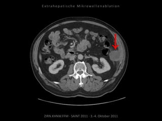 ZIRN.KHNW.FFM · SAINT 2011 · 3.-4. Oktober 2011
E x t r a h e p a t i s c h e M i k r o w e l l e n a b l a t i o n
 