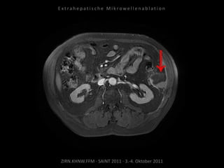 ZIRN.KHNW.FFM · SAINT 2011 · 3.-4. Oktober 2011
E x t r a h e p a t i s c h e M i k r o w e l l e n a b l a t i o n
 
