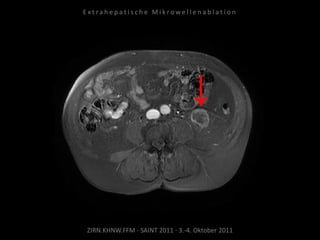 ZIRN.KHNW.FFM · SAINT 2011 · 3.-4. Oktober 2011
E x t r a h e p a t i s c h e M i k r o w e l l e n a b l a t i o n
 