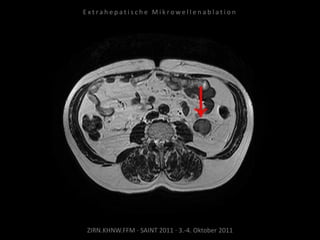 ZIRN.KHNW.FFM · SAINT 2011 · 3.-4. Oktober 2011
E x t r a h e p a t i s c h e M i k r o w e l l e n a b l a t i o n
 