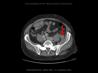 ZIRN.KHNW.FFM · SAINT 2011 · 3.-4. Oktober 2011
E x t r a h e p a t i s c h e M i k r o w e l l e n a b l a t i o n
 