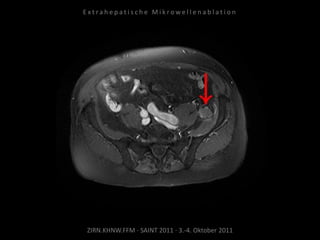 ZIRN.KHNW.FFM · SAINT 2011 · 3.-4. Oktober 2011
E x t r a h e p a t i s c h e M i k r o w e l l e n a b l a t i o n
 