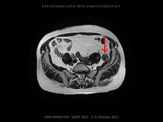 ZIRN.KHNW.FFM · SAINT 2011 · 3.-4. Oktober 2011
E x t r a h e p a t i s c h e M i k r o w e l l e n a b l a t i o n
 