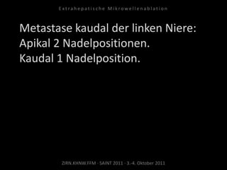 Metastase kaudal der linken Niere:
Apikal 2 Nadelpositionen.
Kaudal 1 Nadelposition.
ZIRN.KHNW.FFM · SAINT 2011 · 3.-4. Oktober 2011
E x t r a h e p a t i s c h e M i k r o w e l l e n a b l a t i o n
 