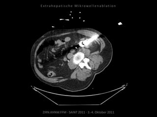 ZIRN.KHNW.FFM · SAINT 2011 · 3.-4. Oktober 2011
E x t r a h e p a t i s c h e M i k r o w e l l e n a b l a t i o n
 