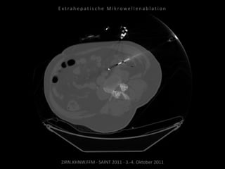 ZIRN.KHNW.FFM · SAINT 2011 · 3.-4. Oktober 2011
E x t r a h e p a t i s c h e M i k r o w e l l e n a b l a t i o n
 
