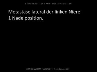 Metastase lateral der linken Niere:
1 Nadelposition.
ZIRN.KHNW.FFM · SAINT 2011 · 3.-4. Oktober 2011
E x t r a h e p a t i s c h e M i k r o w e l l e n a b l a t i o n
 