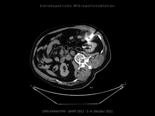 ZIRN.KHNW.FFM · SAINT 2011 · 3.-4. Oktober 2011
E x t r a h e p a t i s c h e M i k r o w e l l e n a b l a t i o n
 