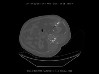 ZIRN.KHNW.FFM · SAINT 2011 · 3.-4. Oktober 2011
E x t r a h e p a t i s c h e M i k r o w e l l e n a b l a t i o n
 