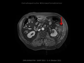 ZIRN.KHNW.FFM · SAINT 2011 · 3.-4. Oktober 2011
E x t r a h e p a t i s c h e M i k r o w e l l e n a b l a t i o n
 