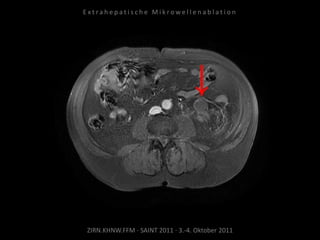 ZIRN.KHNW.FFM · SAINT 2011 · 3.-4. Oktober 2011
E x t r a h e p a t i s c h e M i k r o w e l l e n a b l a t i o n
 