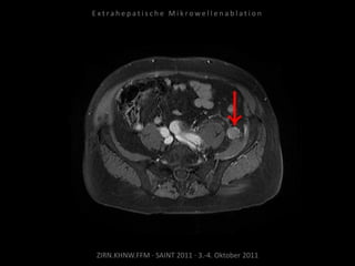 ZIRN.KHNW.FFM · SAINT 2011 · 3.-4. Oktober 2011
E x t r a h e p a t i s c h e M i k r o w e l l e n a b l a t i o n
 