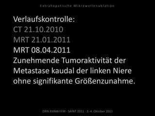 Verlaufskontrolle:
CT 21.10.2010
MRT 21.01.2011
MRT 08.04.2011
Zunehmende Tumoraktivität der
Metastase kaudal der linken Niere
ohne signifikante Größenzunahme.
ZIRN.KHNW.FFM · SAINT 2011 · 3.-4. Oktober 2011
E x t r a h e p a t i s c h e M i k r o w e l l e n a b l a t i o n
 