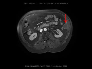 ZIRN.KHNW.FFM · SAINT 2011 · 3.-4. Oktober 2011
E x t r a h e p a t i s c h e M i k r o w e l l e n a b l a t i o n
 