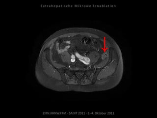 ZIRN.KHNW.FFM · SAINT 2011 · 3.-4. Oktober 2011
E x t r a h e p a t i s c h e M i k r o w e l l e n a b l a t i o n
 