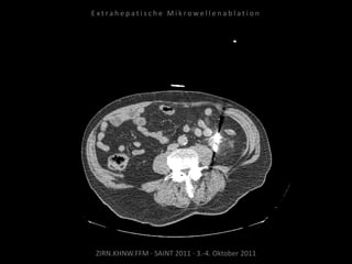 ZIRN.KHNW.FFM · SAINT 2011 · 3.-4. Oktober 2011
E x t r a h e p a t i s c h e M i k r o w e l l e n a b l a t i o n
 