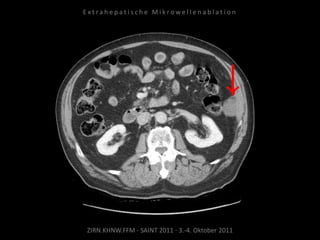 ZIRN.KHNW.FFM · SAINT 2011 · 3.-4. Oktober 2011
E x t r a h e p a t i s c h e M i k r o w e l l e n a b l a t i o n
 